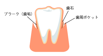 歯周病(歯槽膿漏) - 図解